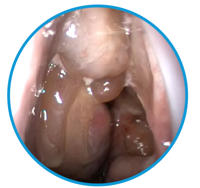 Image showing sinus cavity at baseline