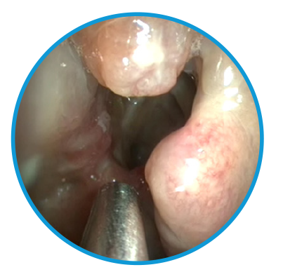 Image showing sinus cavity at day 90